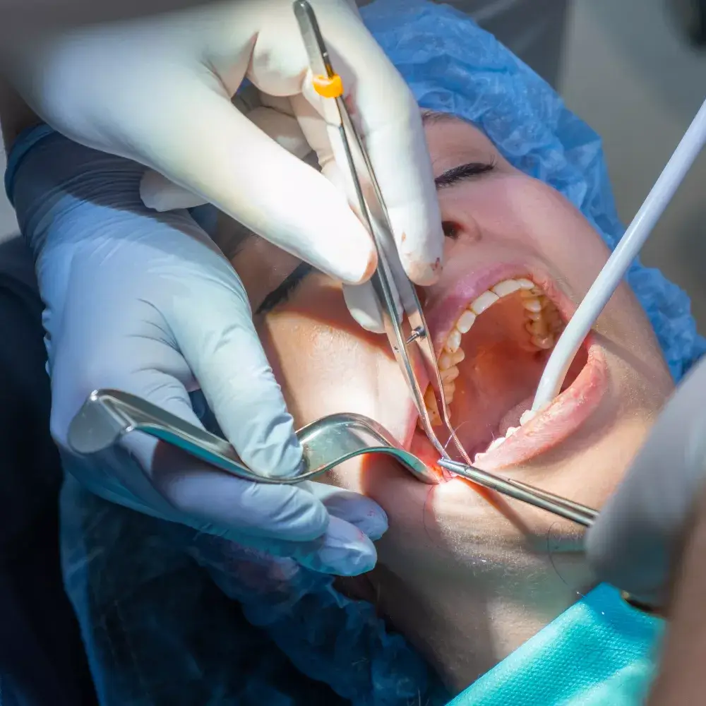 Tooth Extraction