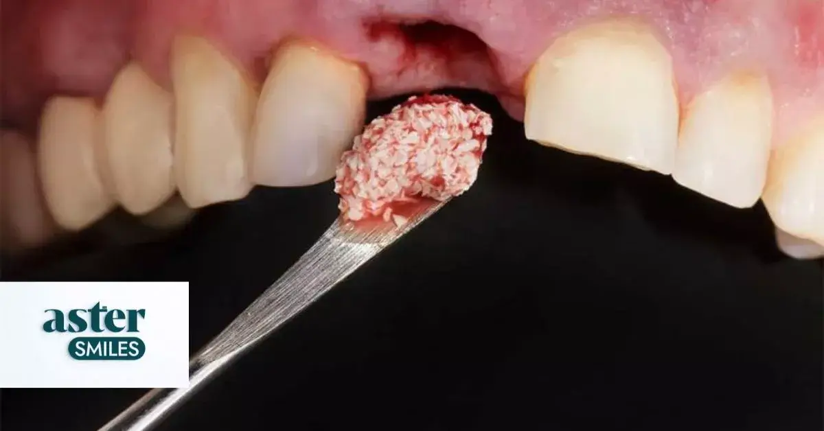 Dental Bone Grafting